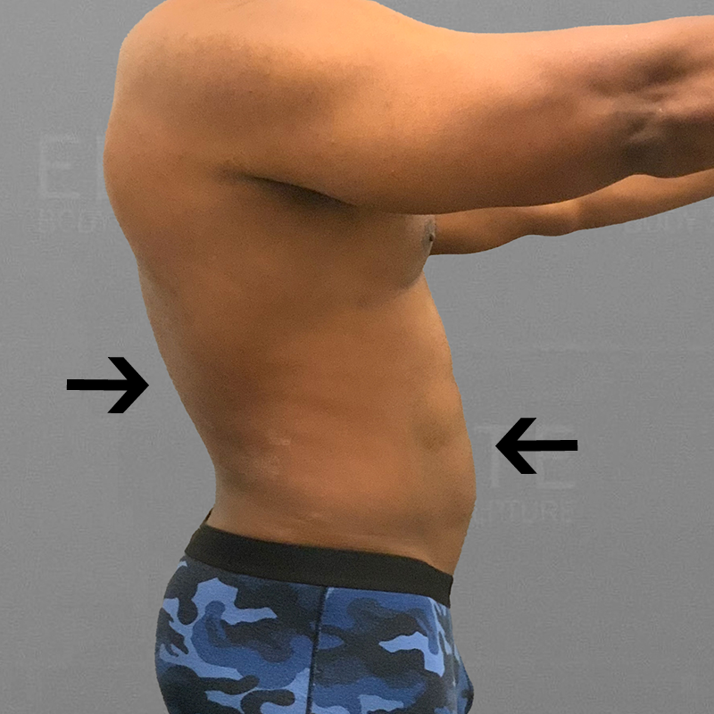 after 48 hour six pack airsculpt