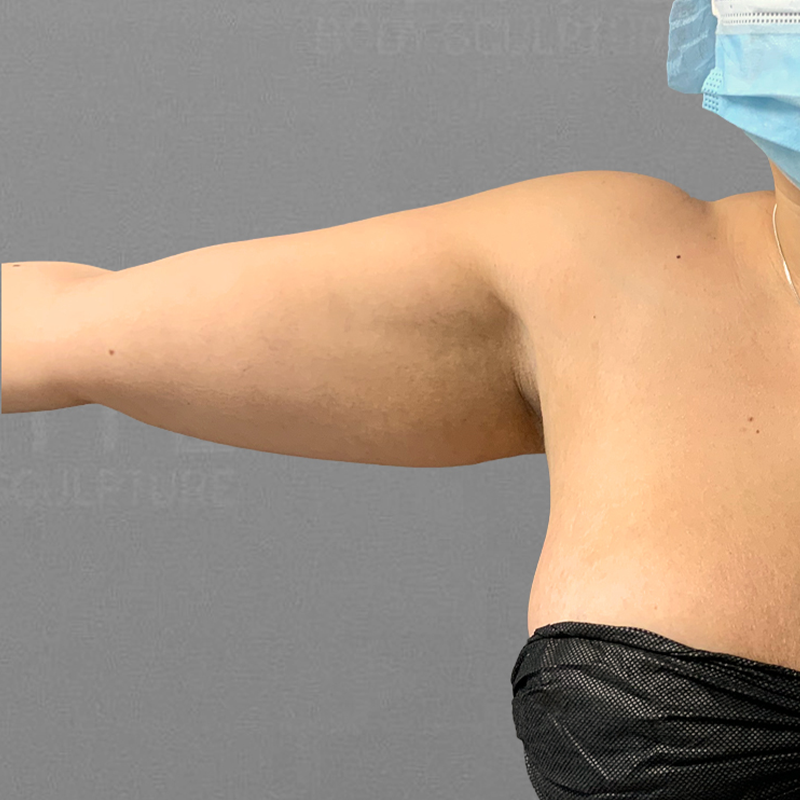 before arm airsculpt