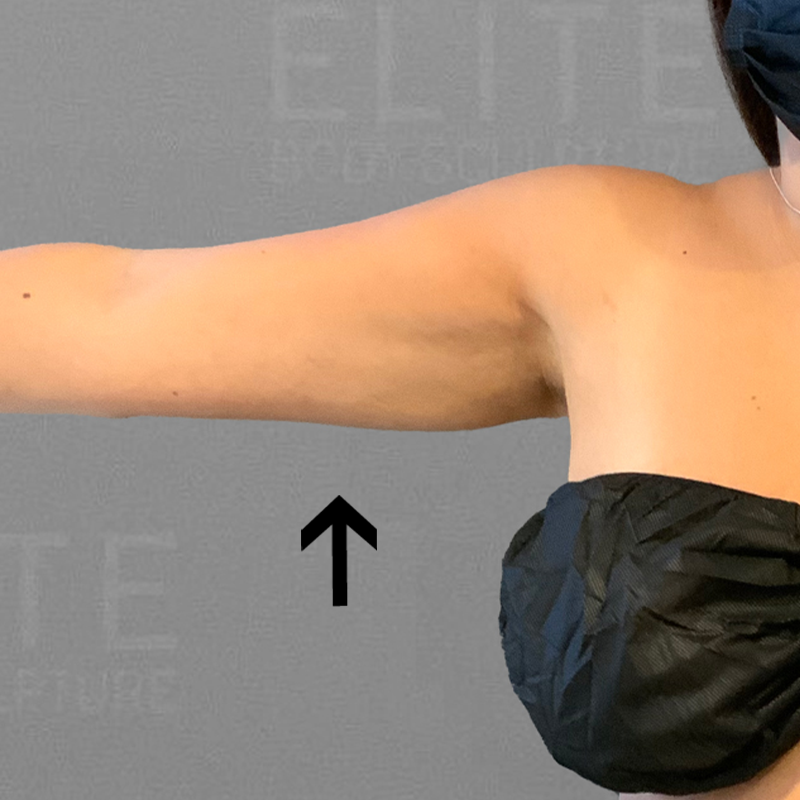 after arm airsculpt