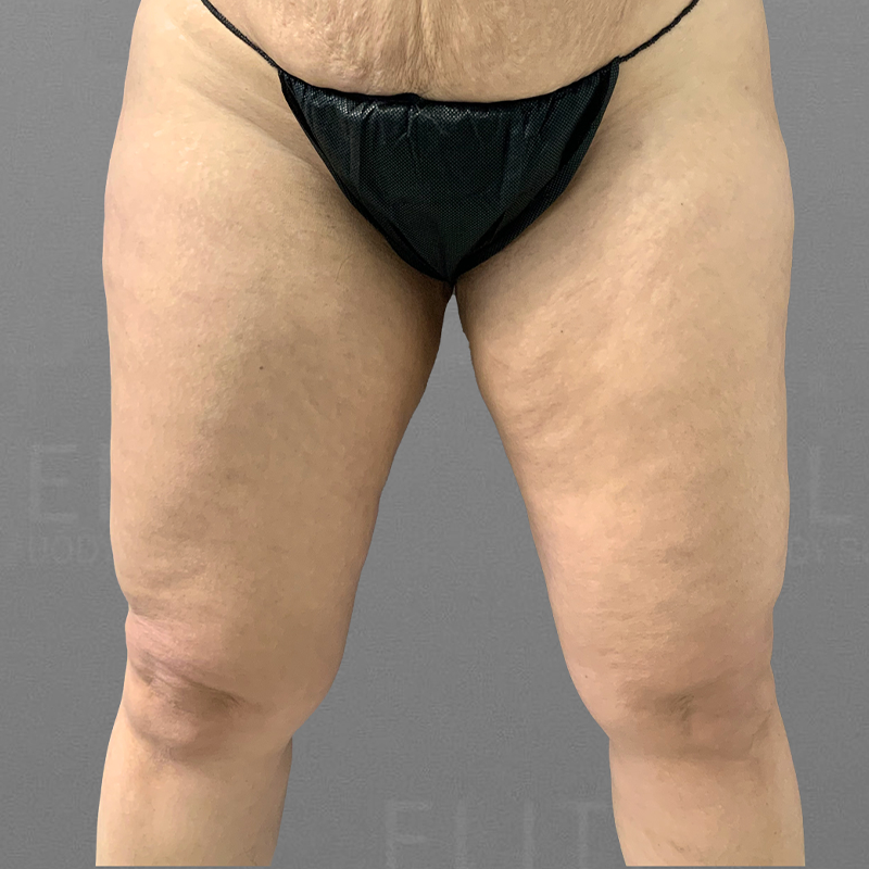 before knee liposuction