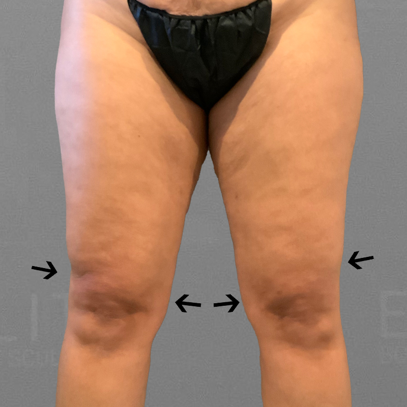 after knee liposuction