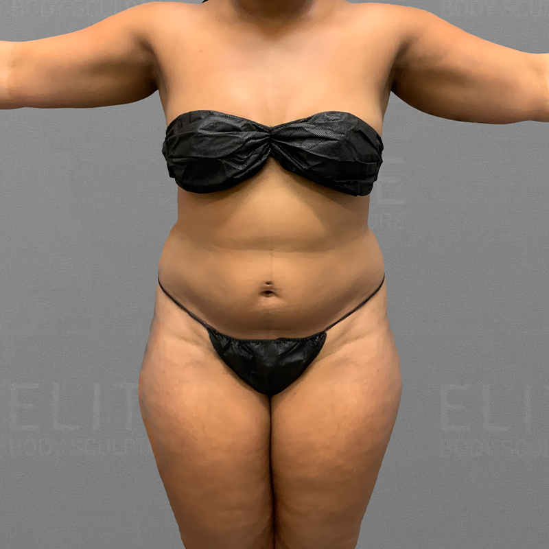 before stomach lipo