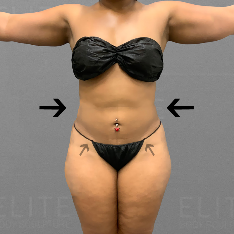 after stomach lipo