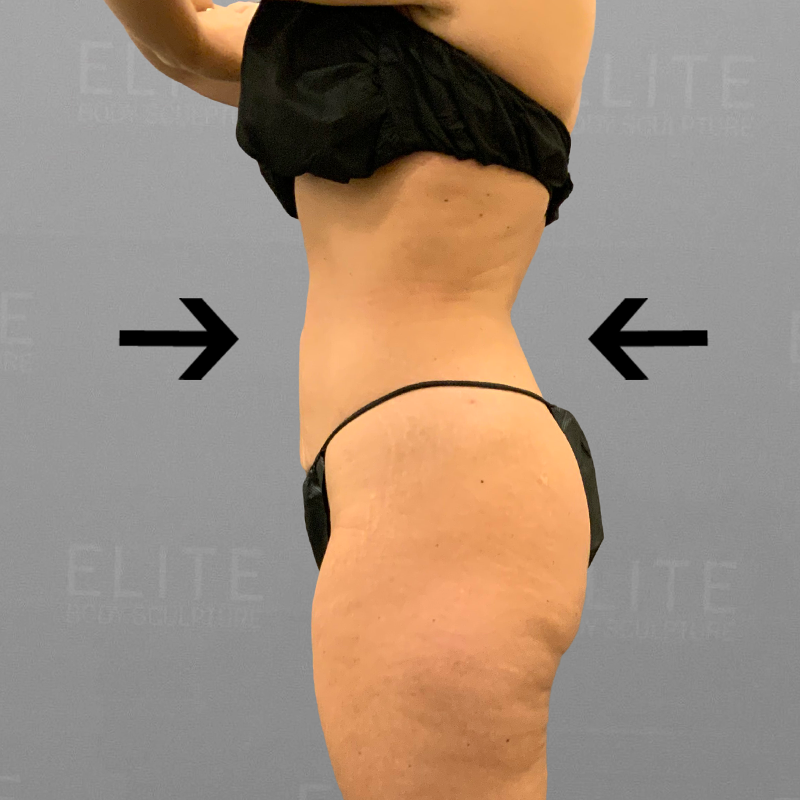 Portia after airsculpt