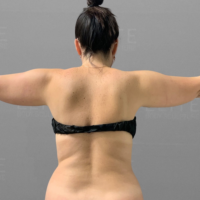 pre arm airsculpt