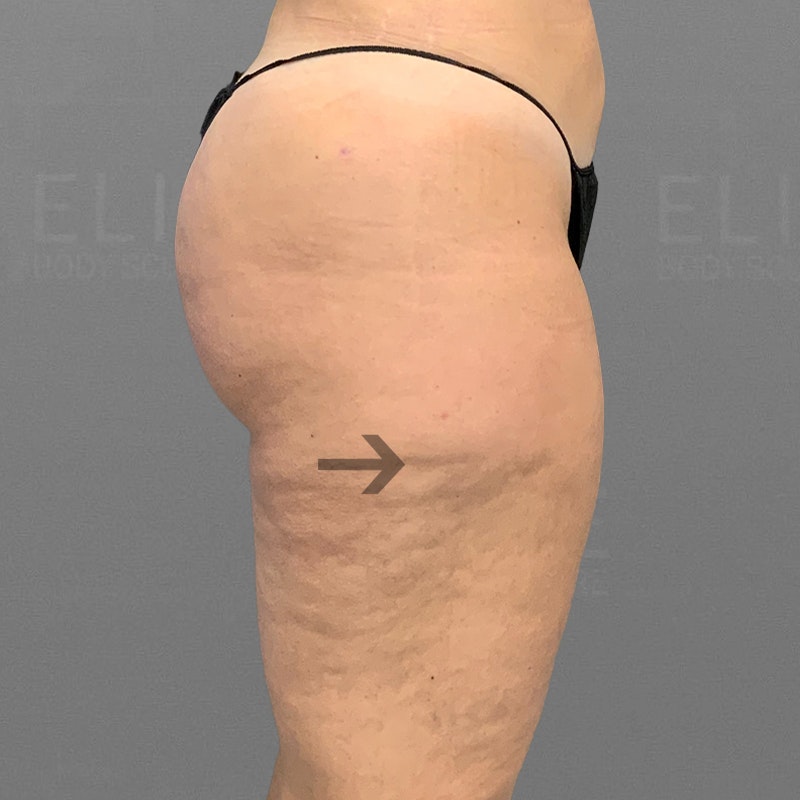 after banana roll lipo
