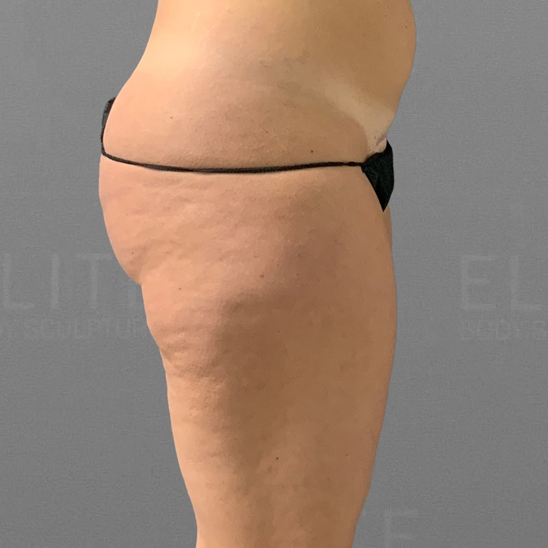 Can Liposuction Treat the Banana Roll Area?