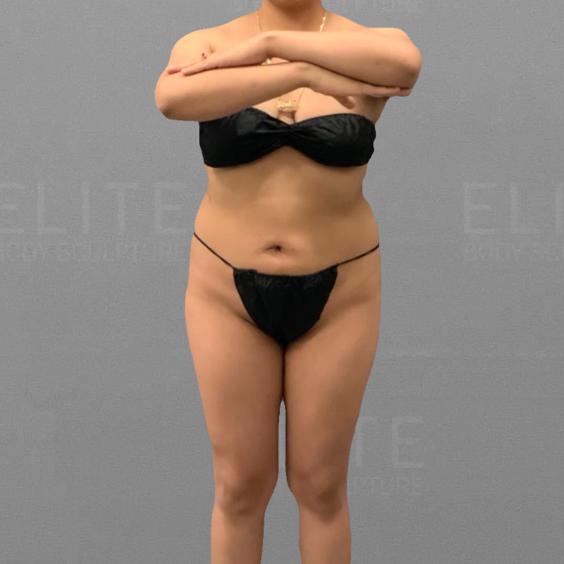 before full abdominal airsculpt bbl