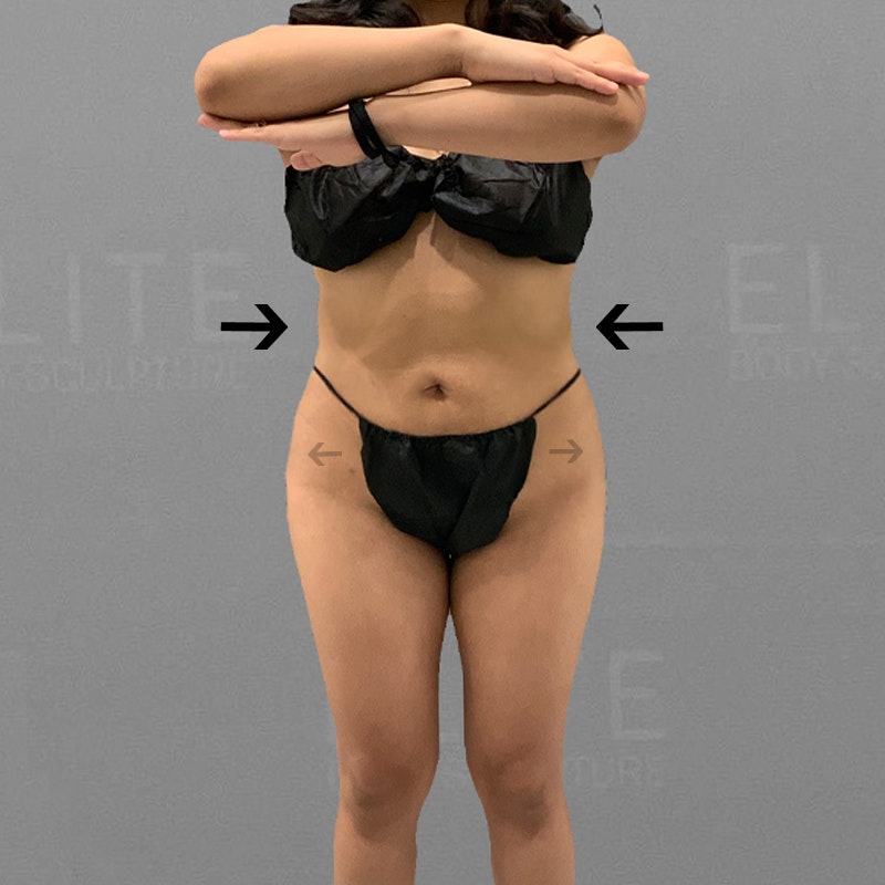 after full abdominal airsculpt bbl