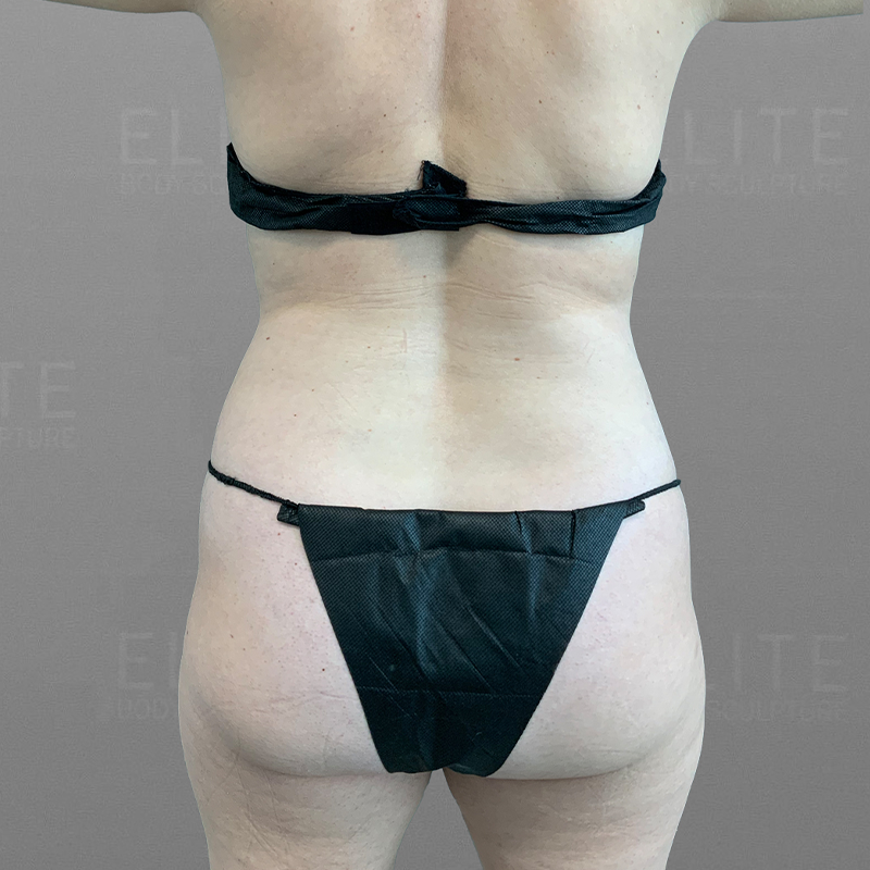 before full abdominal airsculpt