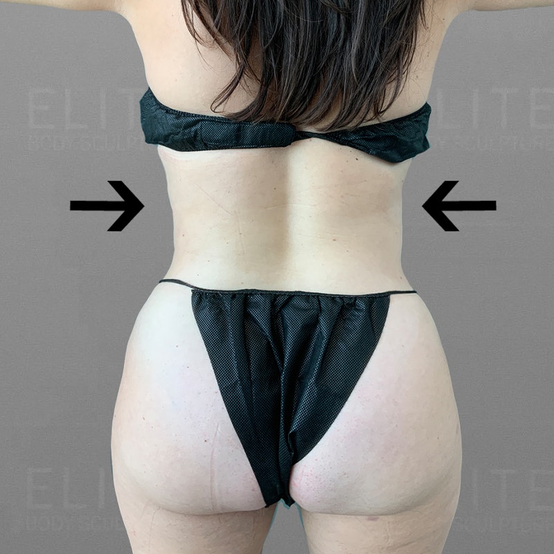 after full abdominal airsculpt