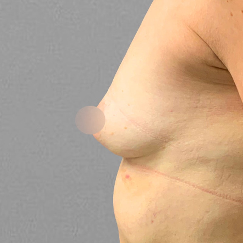before airsculpt breast augmentation