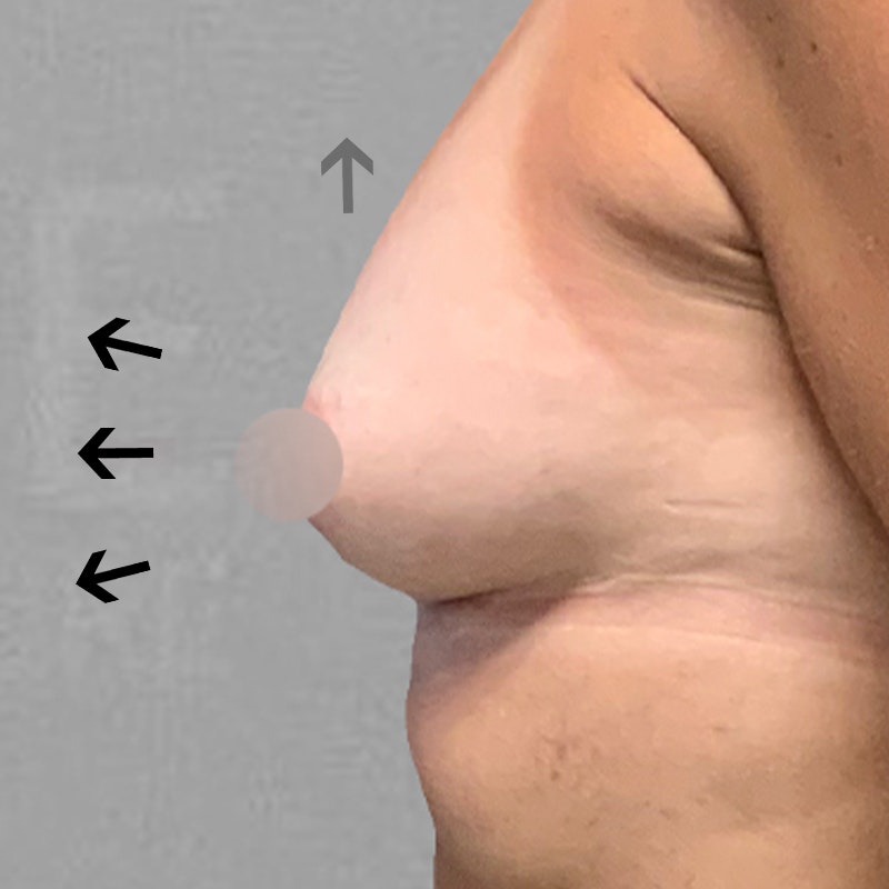 after airsculpt breast augmentation