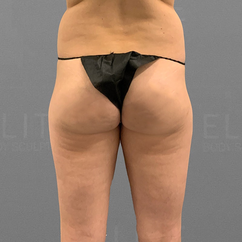 Before inner thigh airsculpt