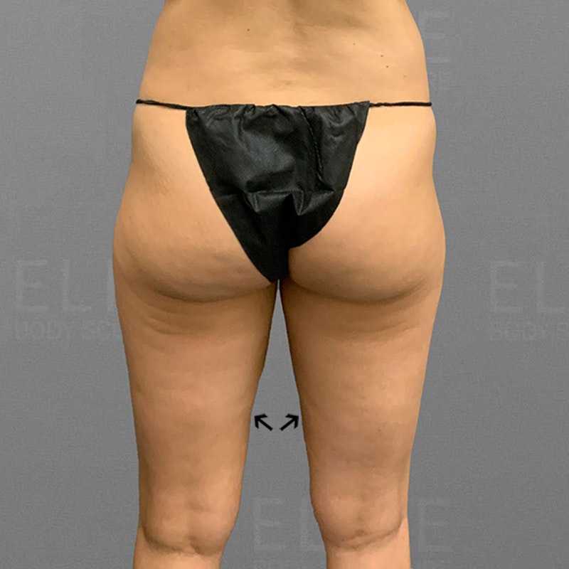 after inner thigh airsculpt