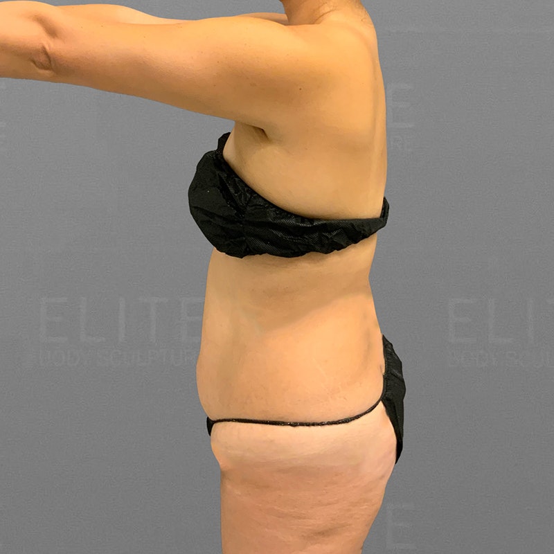 full ab airsculpt before
