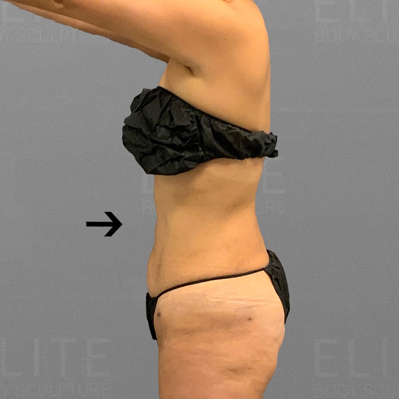 full ab airsculpt after