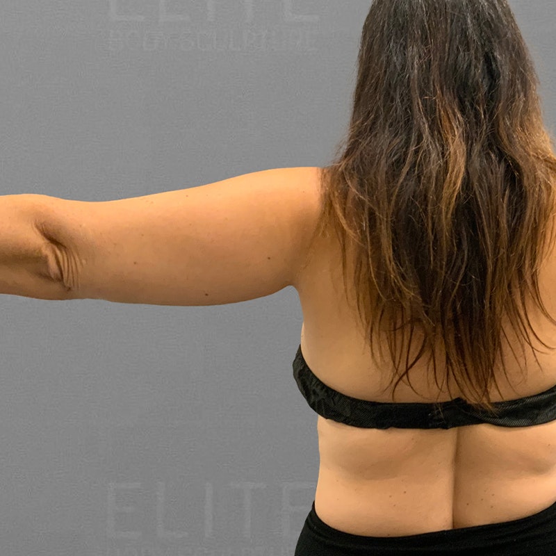 before arm fat removal