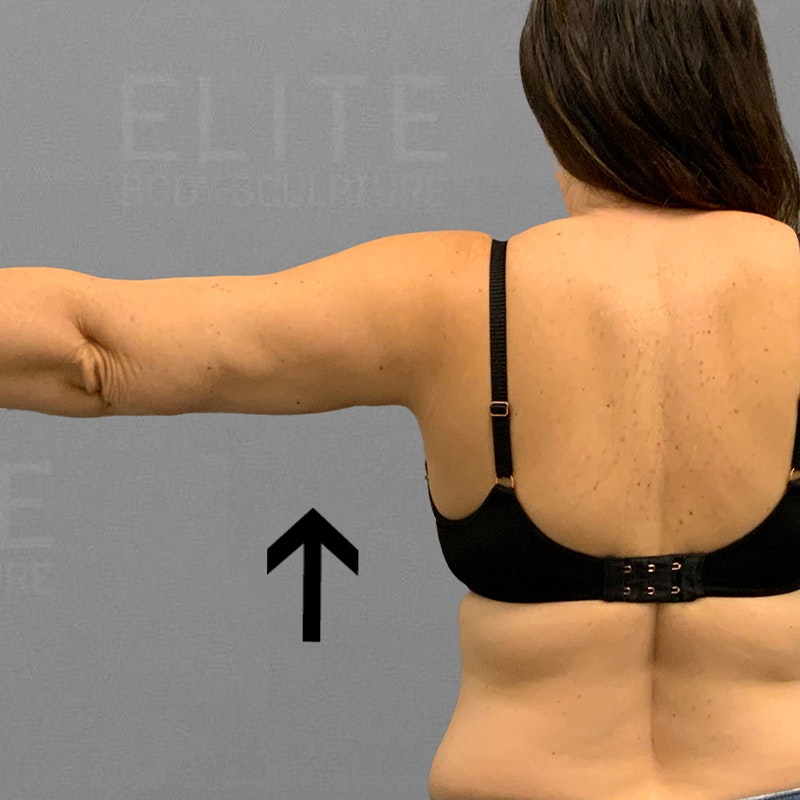 after arm fat removal
