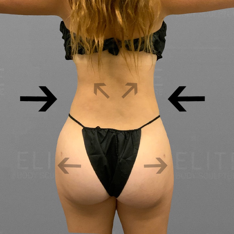 after airsculpt
