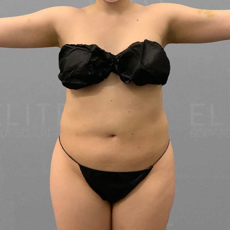 before full ab lipo