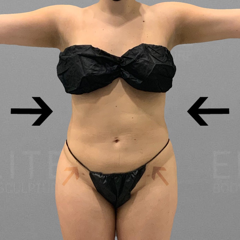 after full ab lipo