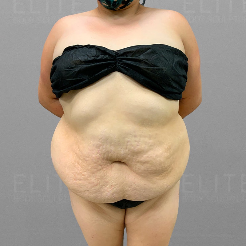 before full ab lipo tiny tuck