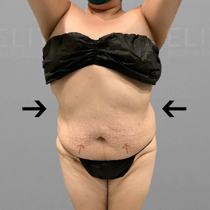 after full ab lipo tiny tuck