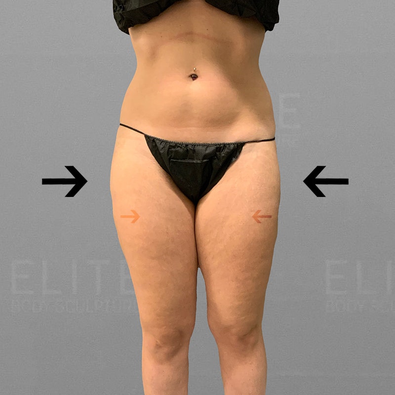 outer thigh after
