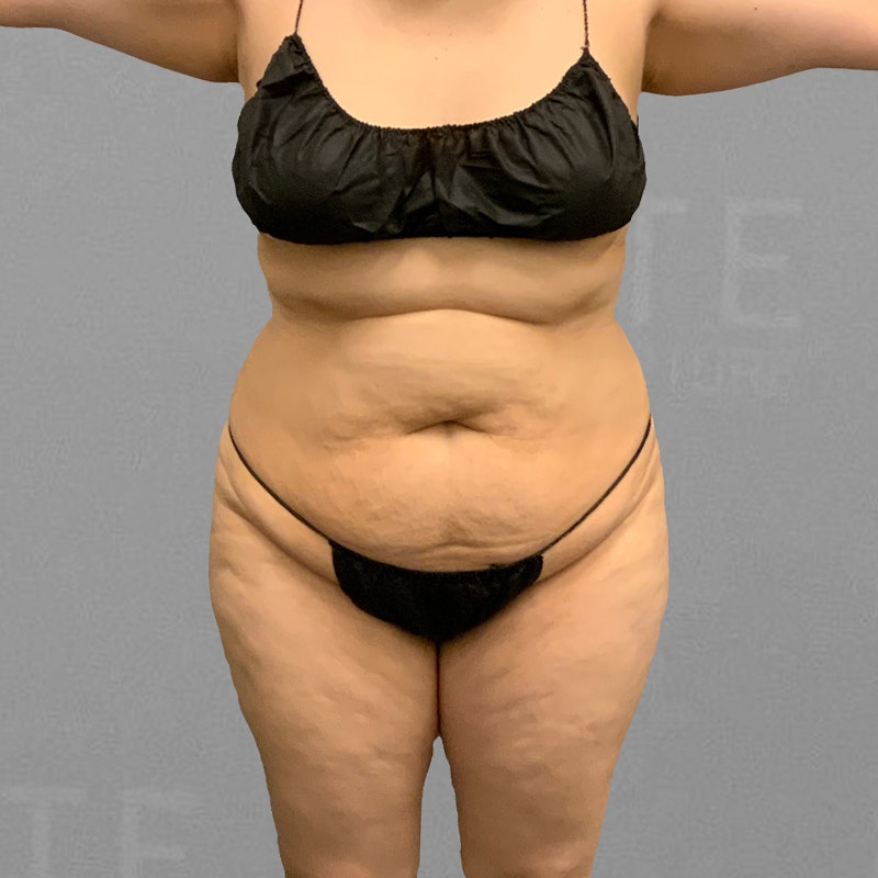 before airsculpt full ab bbl