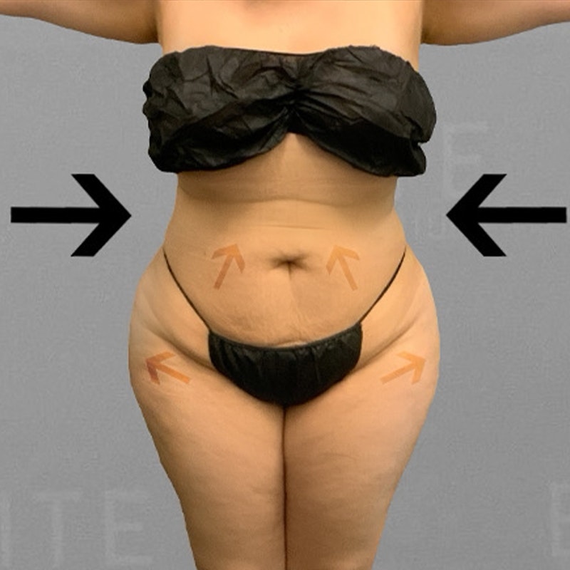 after airsculpt full ab bbl
