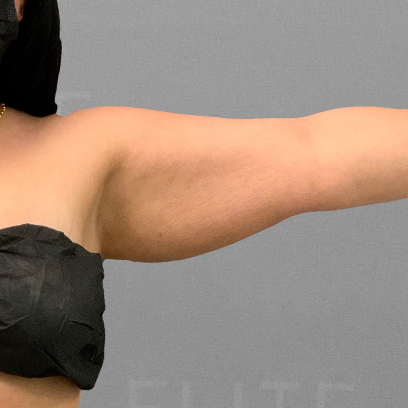before arm airsculpt