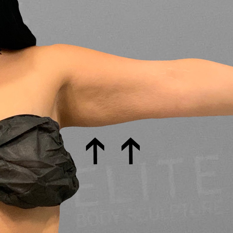 after arm airsculpt