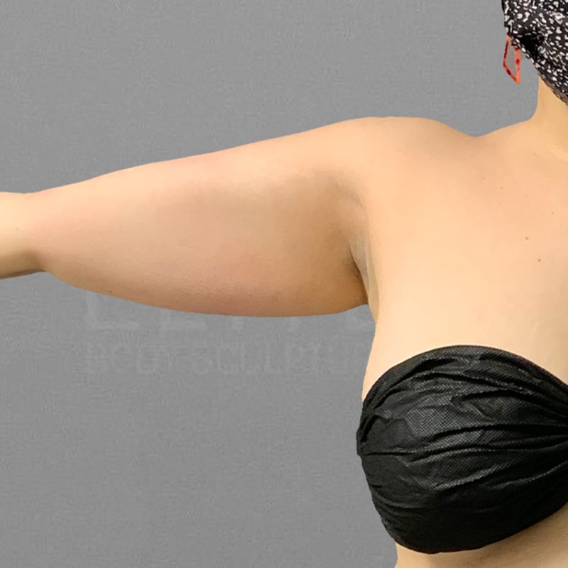 before arm airsculpt