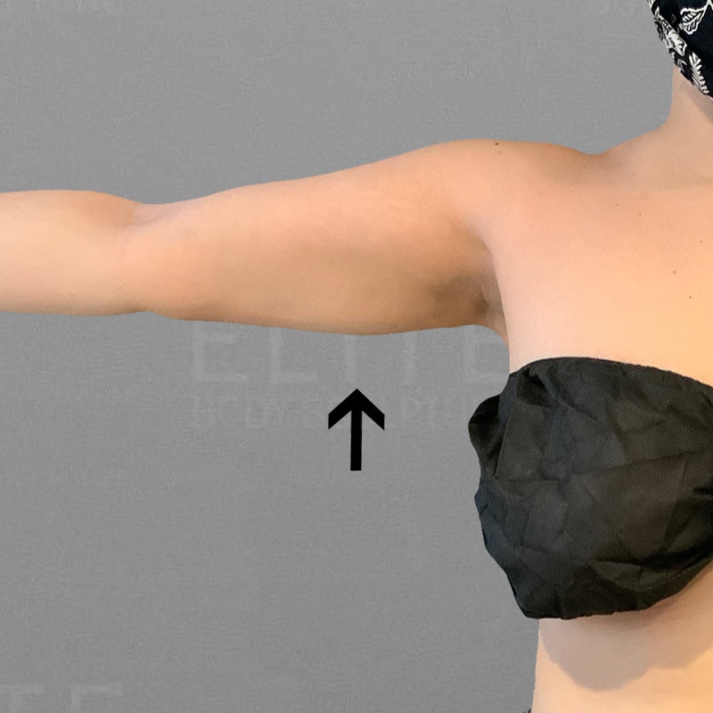 after arm airsculpt
