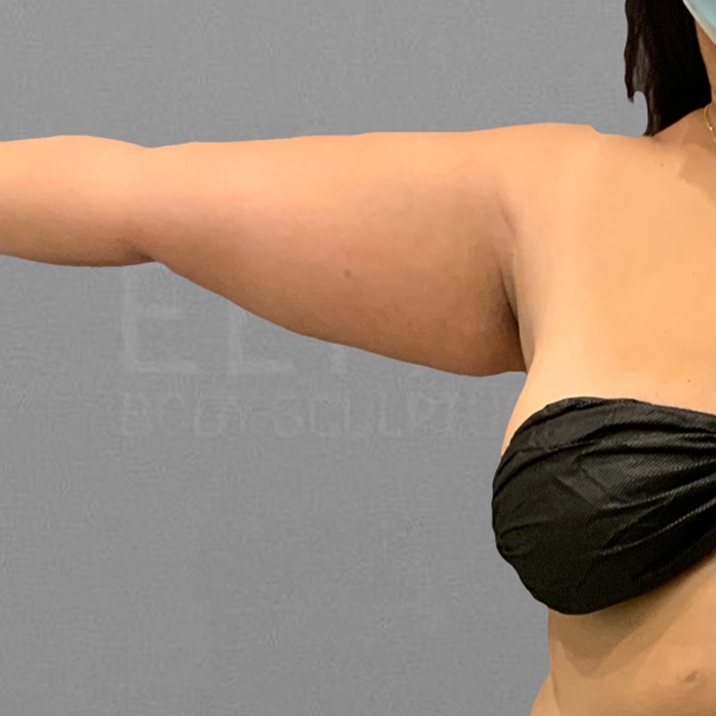 before arm fat removal