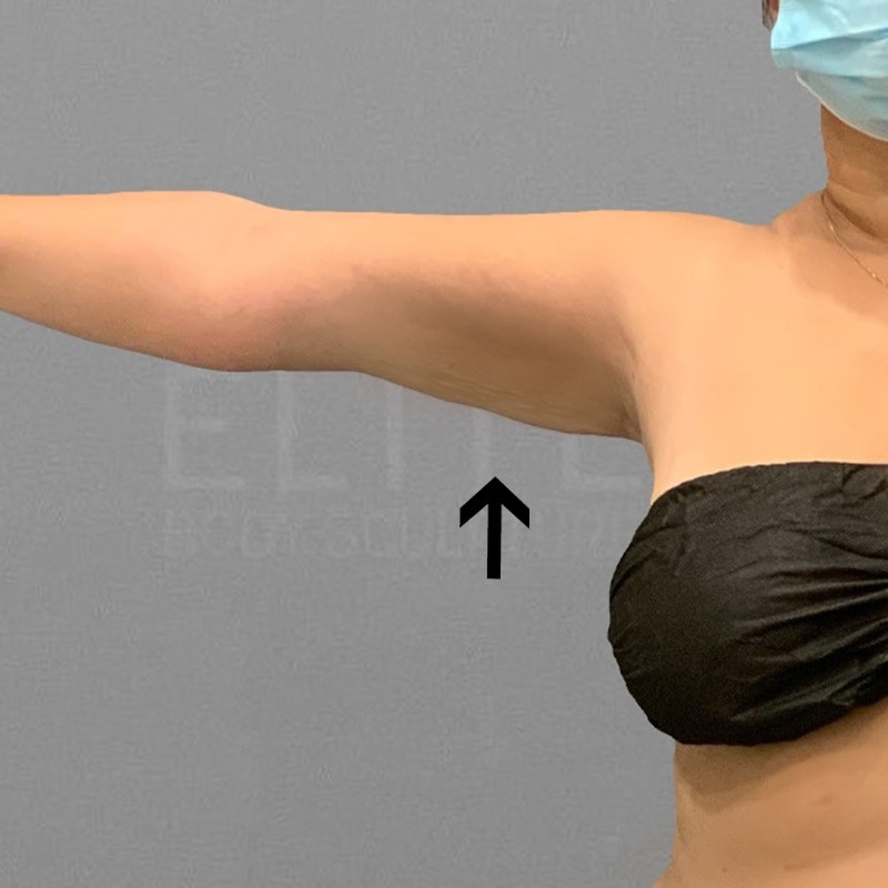 after arm fat removal