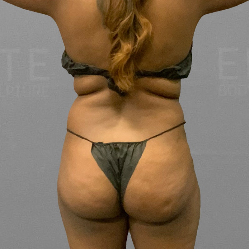 Before airsculpt Idah