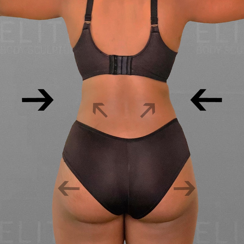 After airsculpt Idah