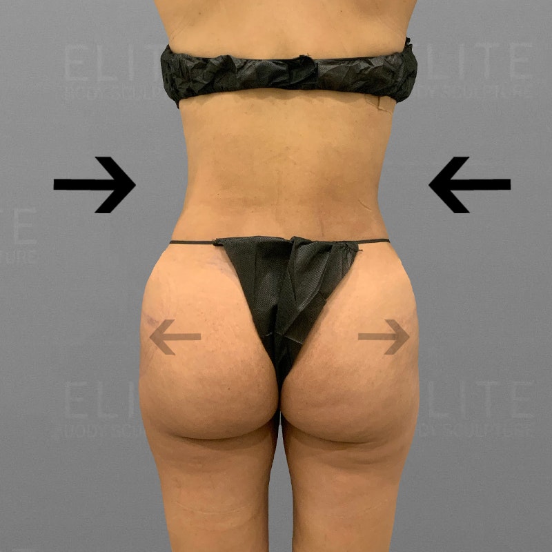 After AirSculpt HipFlip