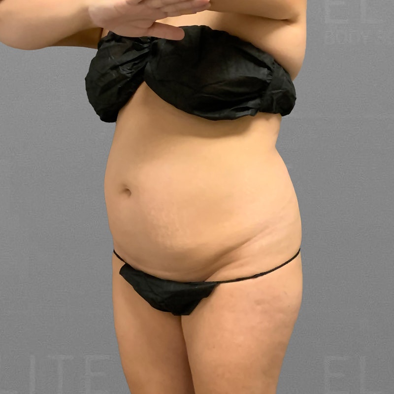 Before Lower Back + Power BBL AirSculpt