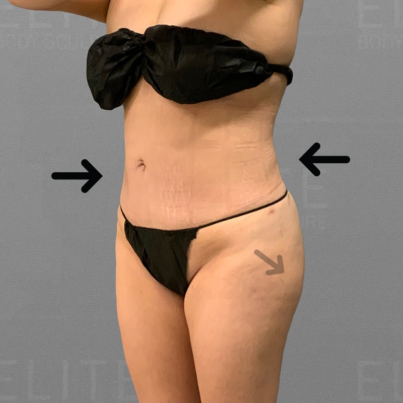 After Lower Back + Power BBL AirSculpt