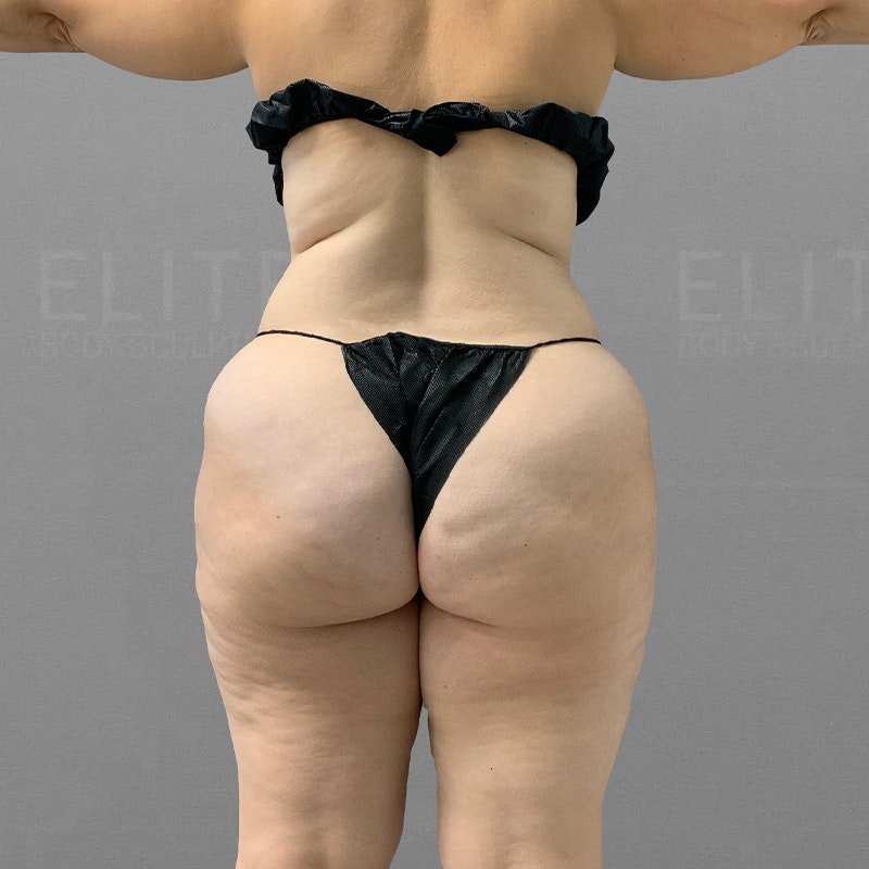 before airsculpt body contouring