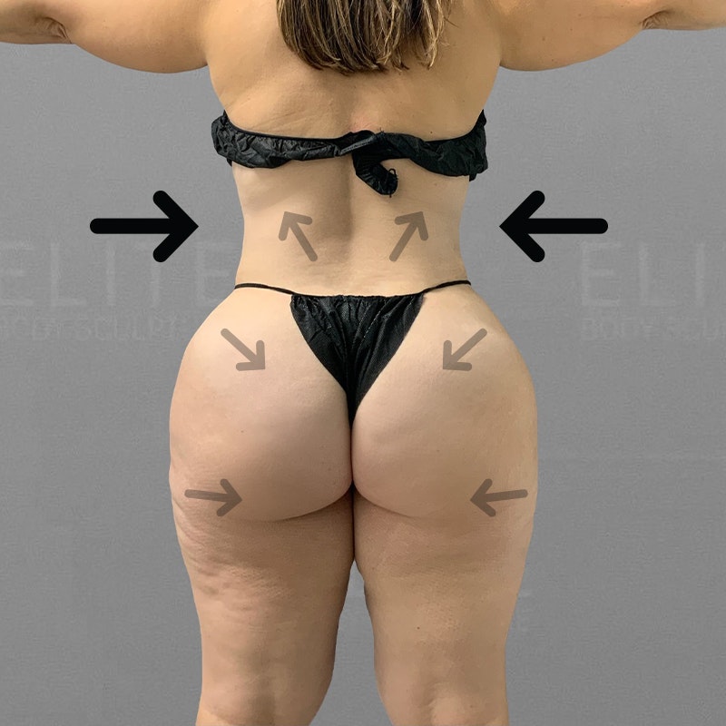 after airsculpt body contouring