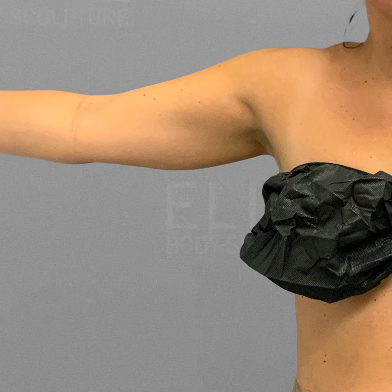 arm airsculpt before