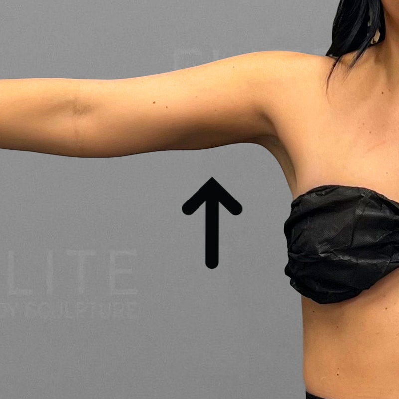 arm airsculpt after