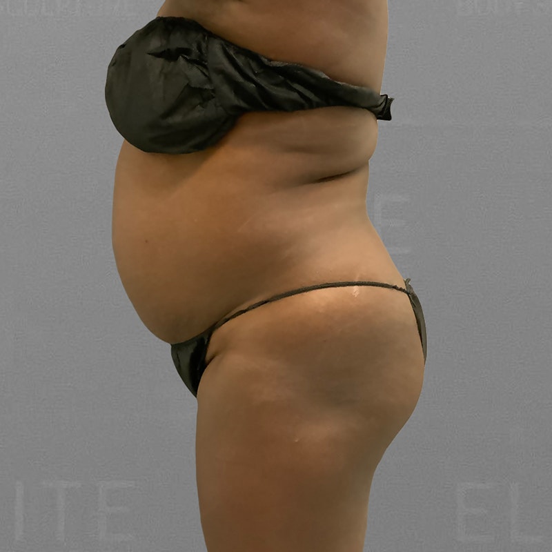 before airsculpt