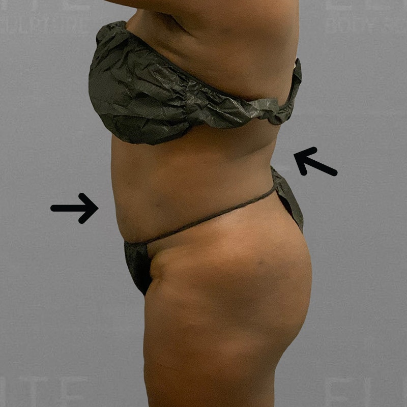 after airsculpt