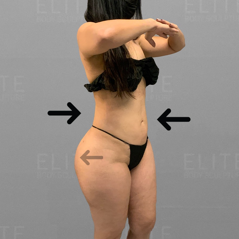 after airsculpt fat transfer
