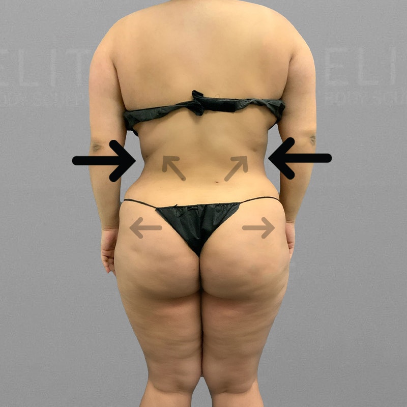 after Full Ab, Back Bra Roll, BBL AirSculpt